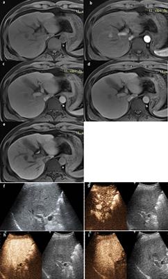 The comparison of contrast-enhanced ultrasound and gadoxetate disodium-enhanced MRI LI-RADS for nodules ≤2 cm in patients at high risk for HCC: a prospective study